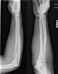 Lathe whipping accident - video and image-broken-arm1.jpg