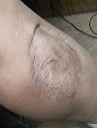 Skin removal tool for skin grafts - photo-20190107_232325.jpgss.jpg